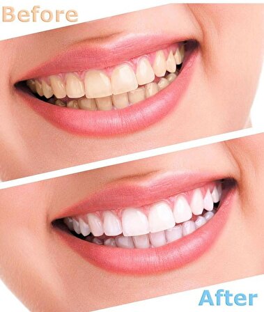 Valkyrie 5 Adet Jel Profesyonel Diş Beyazlatma Seti Parlatıcı Beyazlatıcı Kit